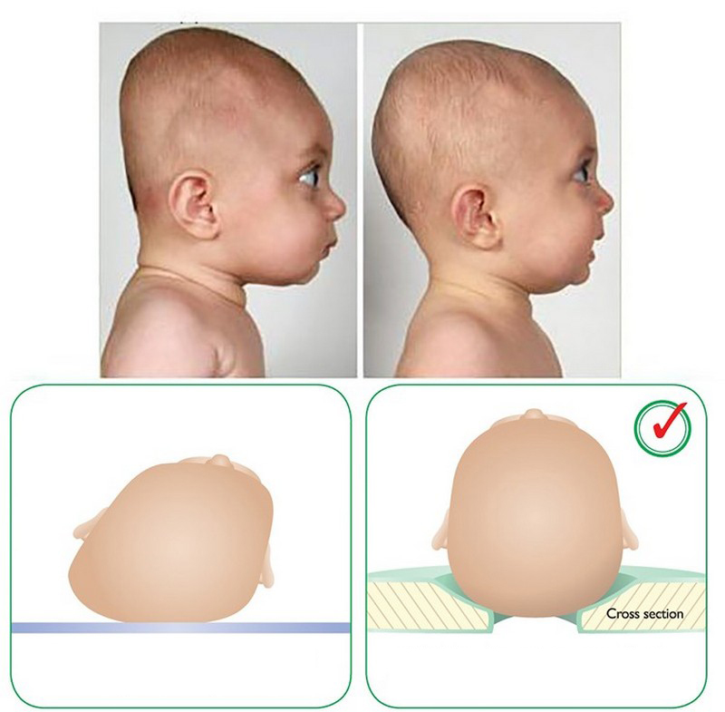 فرم صحیح سر نوزاد چگونه است؟
