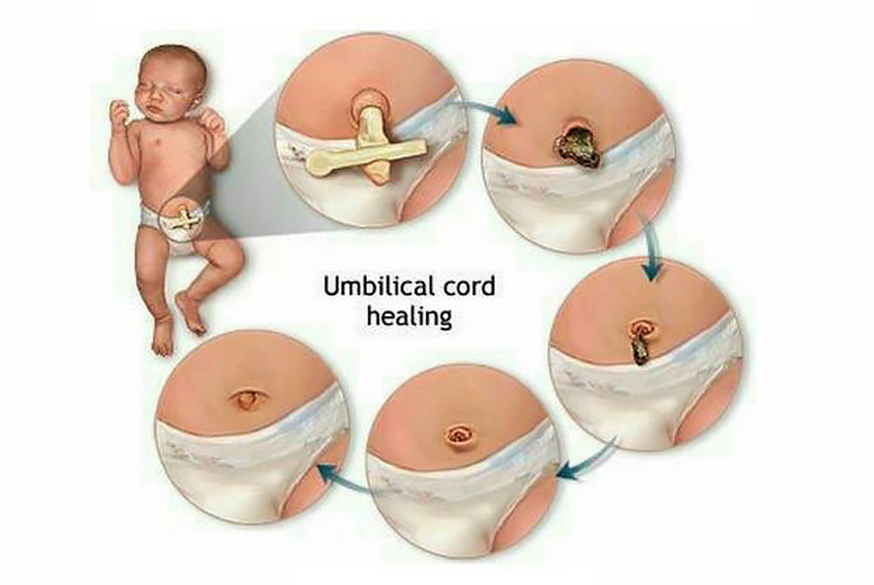 عفونت بندناف